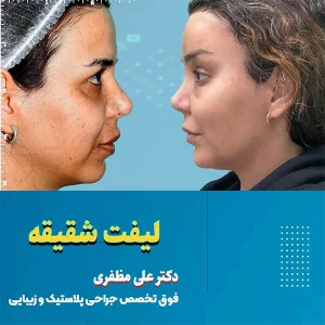 لیفت شقیقه در کرمانشاه |هزینه ، ماندگاری | دکتر علی مظفری