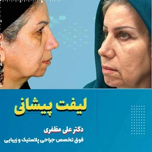 لیفت پیشانی در کرمانشاه - قیمت و روش‌ها | دکتر علی مظفری