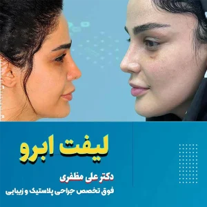 لیفت ابرو در کرمانشاه - هزینه و ماندگاری | دکتر علی مظفری
