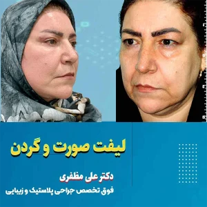 لیفت صورت و گردن در کرمانشاه + قیمت 1404 | دکتر علی مظفری