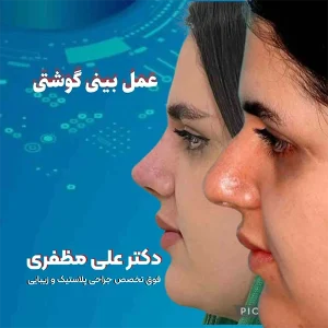 عمل بینی گوشتی در کرمانشاه | دکتر علی مظفری