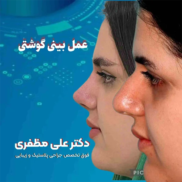 عمل بینی گوشتی در کرمانشاه | دکتر علی مظفری