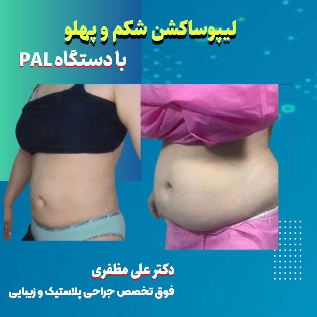 لیپوساکشن با دستگاه PAL در کرمانشاه | دکتر علی مظفری
