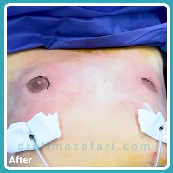 عکس بعد از عمل ژنیکوماستی در کرمانشاه در اتاق عمل | دکتر علی مظفری