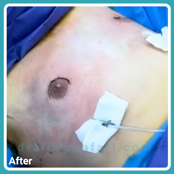 عکس بعد از عمل ژنیکوماستی در کرمانشاه در اتاق عمل | دکتر علی مظفری
